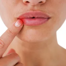 100% Tisztaságú 3 Darabos Afta Ellenes Illóolajcsomag Illusztráció